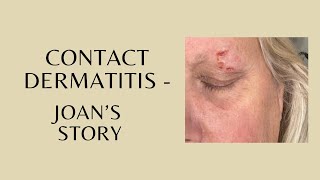 Contact Dermatitis  Joans Story [upl. by Airolg667]