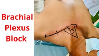 Brachial plexus block  supraclavicular block 🇧🇩 [upl. by Agnot398]