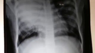 Right lobe consolidation of lung [upl. by Aikcin]