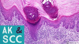 Squamous Cell Carcinoma amp Actinic Keratosis 101Dermpath Basics amp Beyond [upl. by Nnyliak]