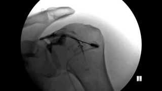 ORTHOMED Shoulder Injection under Fluoroscopic [upl. by Dodd]