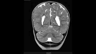 Leucomalácia periventricular [upl. by Giusto183]