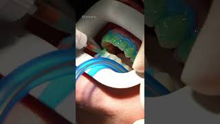 Watch Jolantas Teeth Whitening shorts dentist teethwhitening [upl. by Eybba]