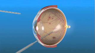 Cirugía de Vitrectomía para Retinopatía Diabética [upl. by Sihtnyc]