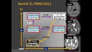 Brain Blood Clots  Imaging Hemorrhage on MR and CT [upl. by Ydnab]