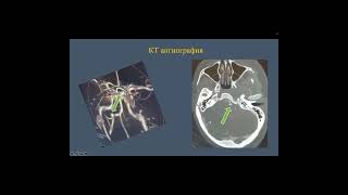 Retrosigmoid Craniotomy for Clipping of a Ruptured PICA Aneurysm [upl. by Eldnik]