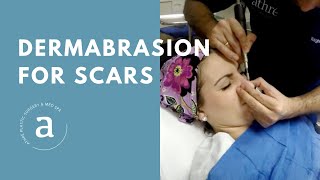 Dermabrasion for Scars  Live Demo by Dr Athre [upl. by Johnstone]