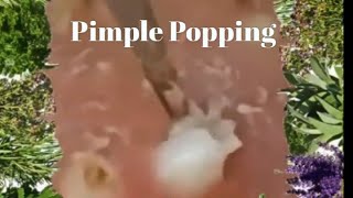 Popping Pimples and Blackheads  3 [upl. by Phelan]