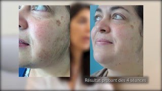 Epilation du visage avec lasers dermatologiques par le Dr Phryné COUTANTFOULC à Nantes 44 [upl. by Elicia]