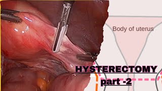 PART  2  NURSING CARE PLAN OF HYSTERECTOMY POST OPERATIVE MANAGEMENT GYNECOLOGICAL NURSING [upl. by Reynard]