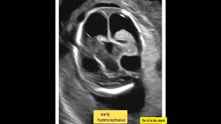 Early hydrocephalus radiology ultrasoundscans ultrasound radiography DoItInTheDark [upl. by Retla714]