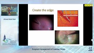 Annual Conference 2023  Surgical Management of Macular Holes  Prof Ahmed Abdel Baki [upl. by Einaj]