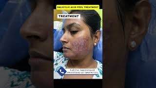 Salicylic acid peel  chemical peel  pimple peeling acne peel druttamkumarlenka acnetreament [upl. by Iris]