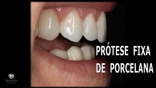 Prótese fixa de Porcelana com Implantes [upl. by Nevur]