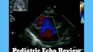 Hypoplastic Left Heart Syndrome [upl. by Erb]