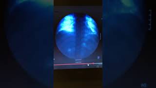 Diaphragm movement under fluoroscopy [upl. by Oicinoid607]