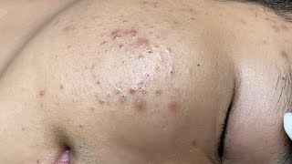 ACNE TREATMENT VU QUYNH MI  Blackheads Of Tweens 2024 EX [upl. by Einohtna]