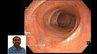 colonoscopyInflammatory bowel diseaseIBDUlcerative colitisEndoscopy biopsyDr Pandiaraja [upl. by Nobell148]