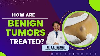 How are benign tumors treated Non  Cancerous Treatment  Dr PK Talwar [upl. by Courtnay]