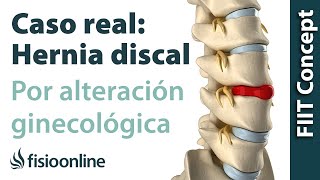 Hernia discal lumbar por una alteración ginecológica  Caso clínico real [upl. by Enel503]