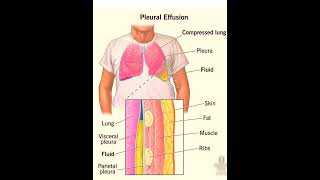 Pleural effusion Lungs disorderchati me pani hona छाती में पानी होनाbiology anatomyicunursing [upl. by Naujud]