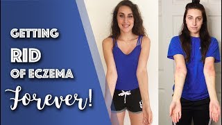 How I CURED my Eczema in 6 Months 5 Diet Tips [upl. by Ailuj]