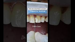 Midline Closure Composite Bonding [upl. by Manda]