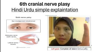 6th cranial nerve palsy in hindi urdu  simple explaintation  cranialnerves plasy [upl. by Merrell25]