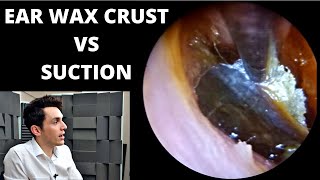 Encrusted Ear Wax VS Suction [upl. by Ail514]