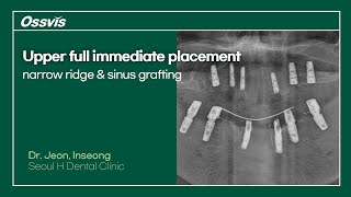 Clinical Case Upper full immediate placement on narrow ridge amp sinus grafting [upl. by Kingsbury809]