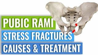 Pubic Ramus Stress Fractures Treatment [upl. by Nomyaw]