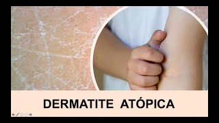 DERMATITE ATÓPICA  ECZEMA [upl. by Thorpe]