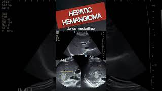 HEPATIC HEMANGIOMA liver diagnosis ultrasound [upl. by Bradwell]