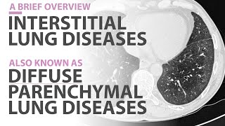 Interstitial Lung Diseases ILD or Diffuse Interstitial Lung Diseases DPLDs A Brief Overview [upl. by Burtie]