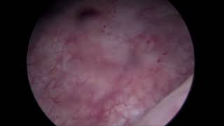 Cistoscopia en cistitis intersticial [upl. by Lauralee]