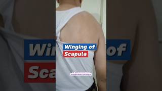 Winging of scapula viral education physiotherapy [upl. by Gulick]