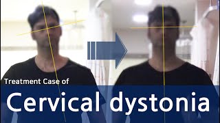 Dystonia  Cervical Dystonia  Spasmodic Torticollis  사경증 치료사례  근긴장이상증 [upl. by Aniat]