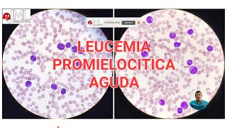 PROMIELOCITOS PATOLÓGICOS LEUCEMIA PROMIELOCÍTICA AGUDA MORFOLOGÍA [upl. by Eiluj]