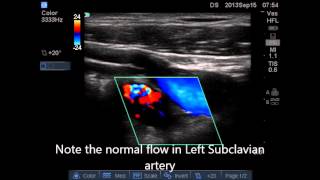 Emergency Ultrasound Case Acute Upper Limb Ischemia [upl. by Ebbarta]