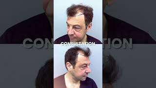 Dr Gökay Bilgin Evaluated Marcos 12 Months Hair Transplant Result [upl. by Meensat686]