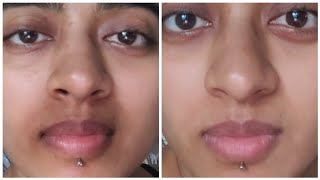 How I ACTUALLY got Rid of Pigmentation Around my Mouth  Pigmentation Treatment For Mouth Darkness [upl. by Resiak]