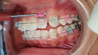 Opciones para brackets ESTÉTICOS [upl. by Tiler]