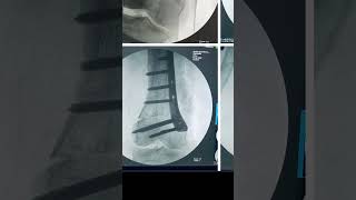 Can knock knees be corrected with surgery DFO distal femoral Osteotomy [upl. by Tyler]