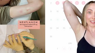 Healing After Nexplanon Birth Control Implant Removal [upl. by Orthman]