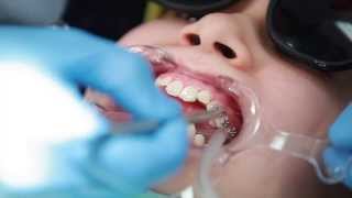 Braces Putting Braces On Bonding Procedure  Aura Orthodontics [upl. by Adnir]