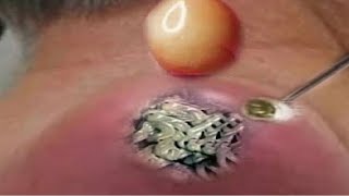 BLACKHEAD PIMPLES REMOVAL OF THE ELDERLY IN CAN THO  5016 [upl. by Atiuqan894]