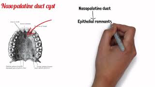 FISSURAL CYSTS  ORAL PATHOLOGY [upl. by Brighton]