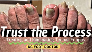 Trust The Process Treating and Eliminating Toenail Fungus [upl. by Ymmak]