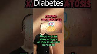 Eruptive Xanthomatosis Pictures amp Treatment Diabetes amp Diagnosis [upl. by Nicram]