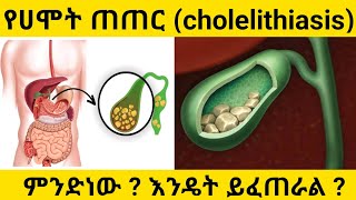 የሀሞት ጠጠር cholelithiasis ምንድነው  እንዴት ይፈጠራል ፣ ምልክቶቹ እና ህክምናው [upl. by Lubet604]